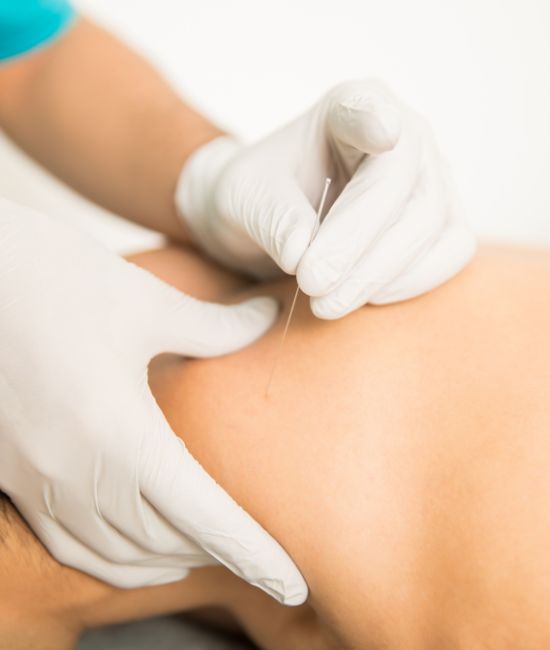 Dry Needling Physiotherapy Treatments